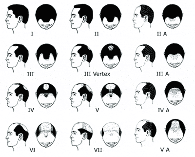 male pattern baldness crown
